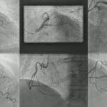 Coronarografia: o investigație vitală pentru sănătatea inimii tale
