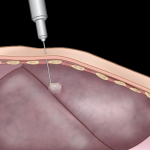 Biopsia pulmonară: ghidul pacientului