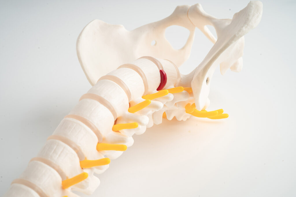 Vertebroplastia