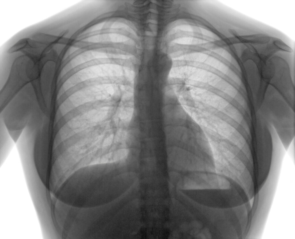 Pneumotoraxul spontan: De ce apare și cum se tratează?