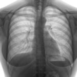 Pneumotoraxul spontan: De ce apare și cum se tratează?