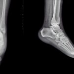 Picior plat, picior convex sau metatarsus adductus la copii