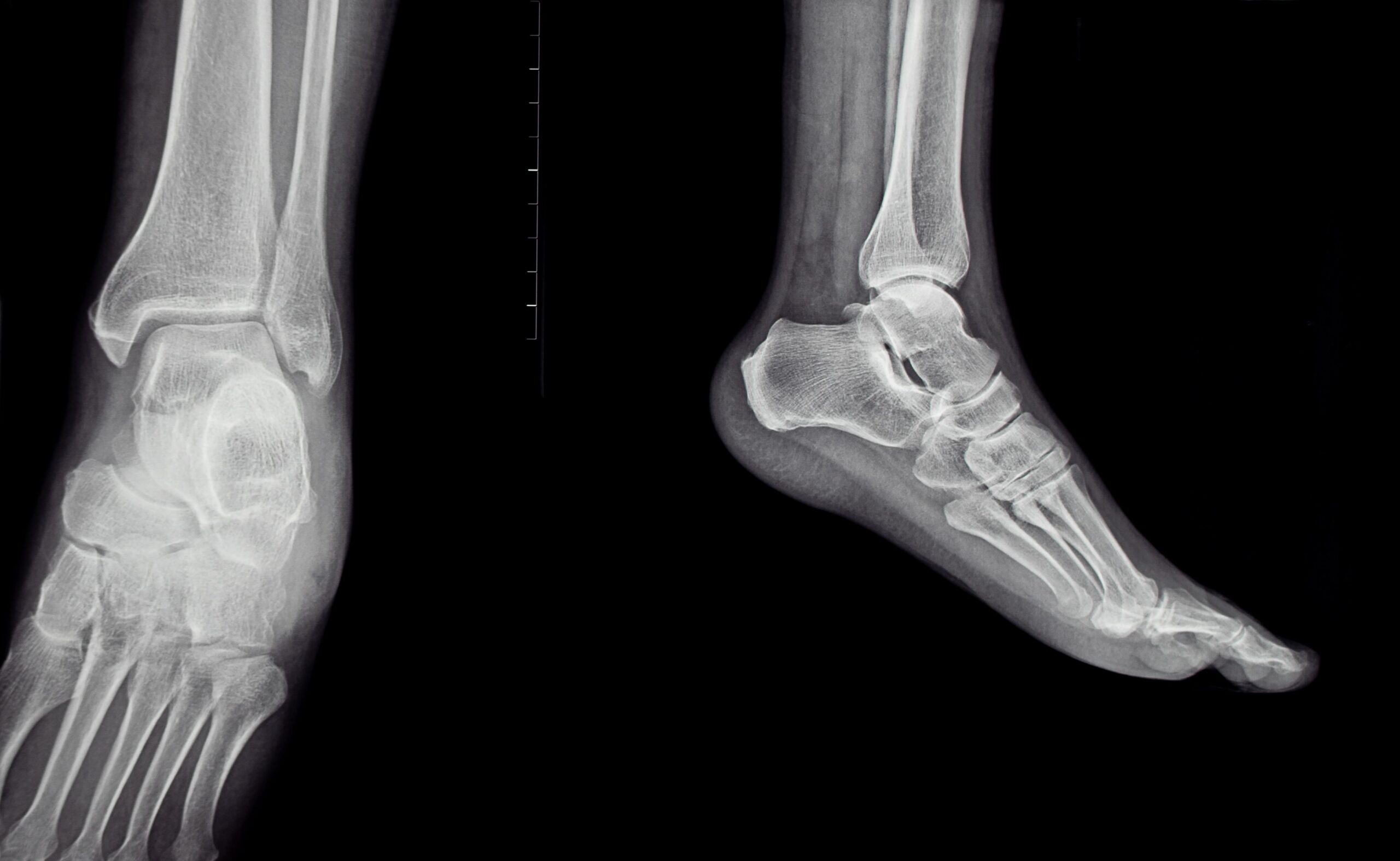 Picior plat, picior convex sau metatarsus adductus la copii