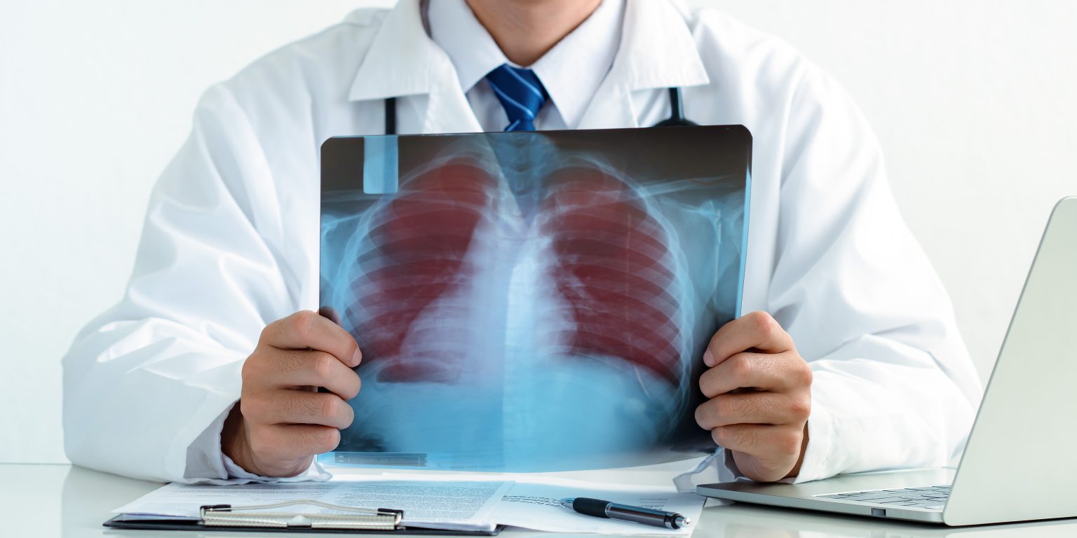 Medic care ține o radiografie toracică cu imaginea plămânilor
