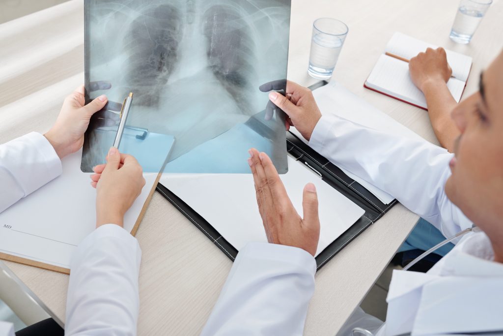 Tumor Board și planul terapeutic în cancerul pulmonar
