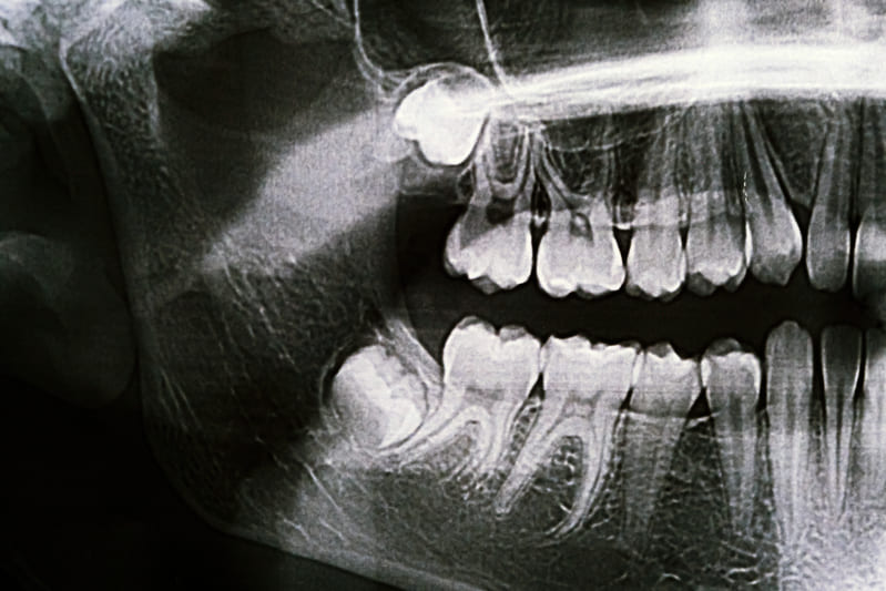 radiografie molari de minte inclusi